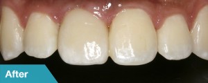 dental-single-after