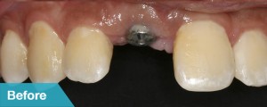 dental-single-before