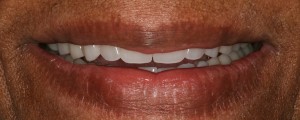 full-denture-smile