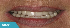 porcelain-crowns-after